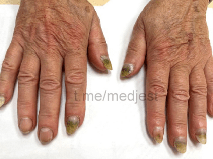 Синегнойная палочка поселилась на ногтях у нижегородки из-за гель-лака