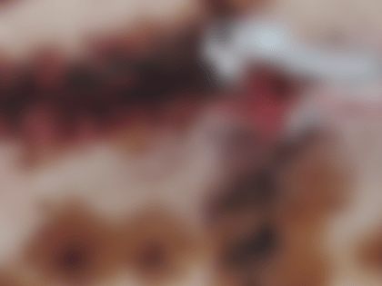 Успешная операция по удалению карбункула в Нижнем Новгороде