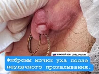 Фибромы появились у нижегородки после прокалывания мочки уха