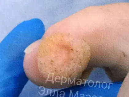 Получился гигант. Нижегородец хотел удалить бородавку, но что-то пошло не так