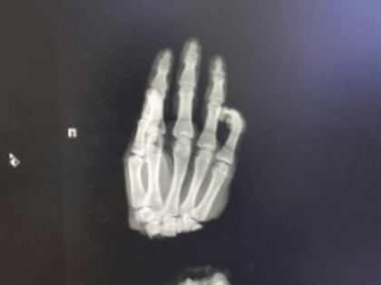 Нижегородские медики пришили подростку из Коврова отрубленную руку