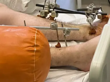 «На восстановление уйдет год»: подробности жуткого ЧП с нижегородцем