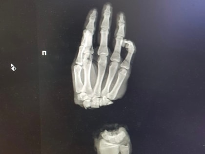 Нижегородские хирурги пришили подростку отрубленную топором кисть