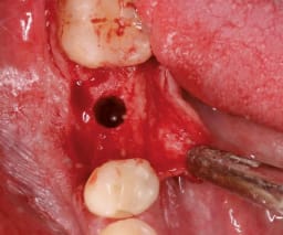 NENTWIG, Bone Spread.Instr., F.4, baj., skal