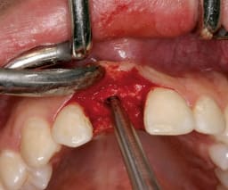 NENTWIG, Bone Spread.Instr., F.4, ger., skal