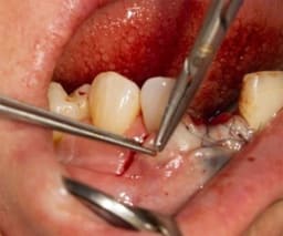 IÂ´Motion, Micro-Nadelhalter, 18 cm, Hartmetall, gerade