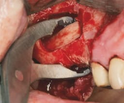 NENTWIG, Knochenfixier-u.haltezange, ger.