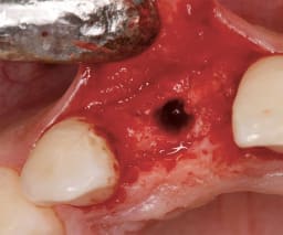 NENTWIG, Bone Spread.Instr., F.1, ger., skal