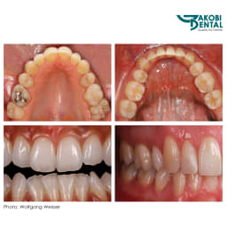 PM-Demister Kit PROFESSIONAL consist. of: PMD with mirrors # 03, 03, 05, 05, ventilation & lighting, retractors, lithium battery (3,7V / 900mAh),