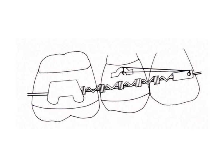 NiTi Molar Distalization Spring 150g Bars 3x17.8cm