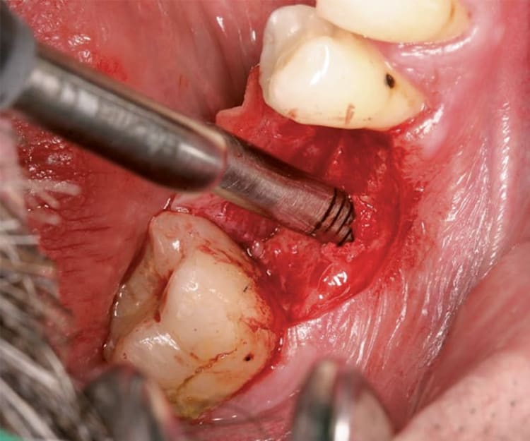 NENTWIG, Bone Spread.Instr., F.1, ger., skal