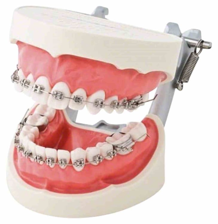 Brackets-Demo Modell OK+UK+Artik.St