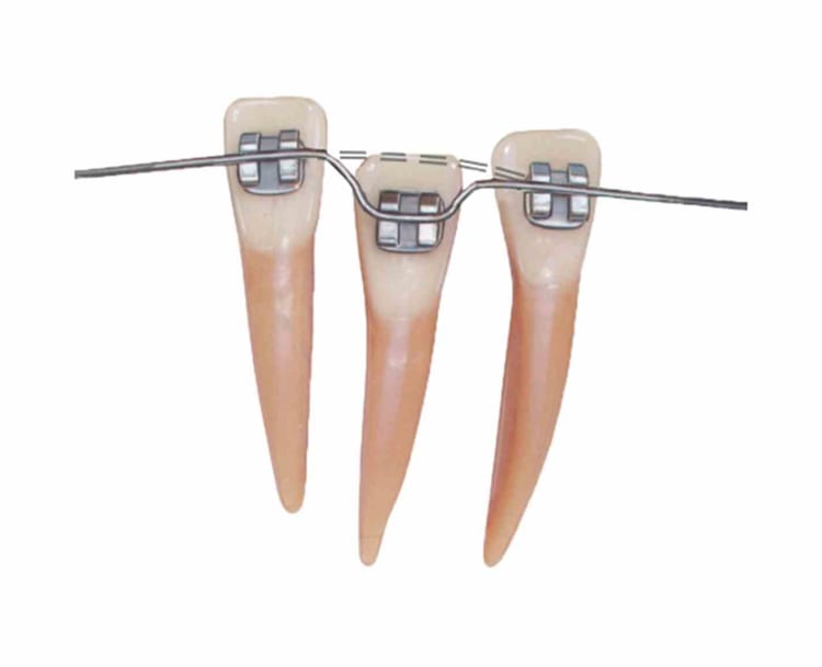 Titanol UK Bogen .012 204-0930 Pa