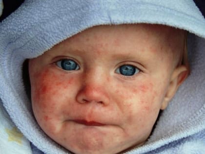 С начала года в Северной Осетии было зарегистрировано 19 случаев кори