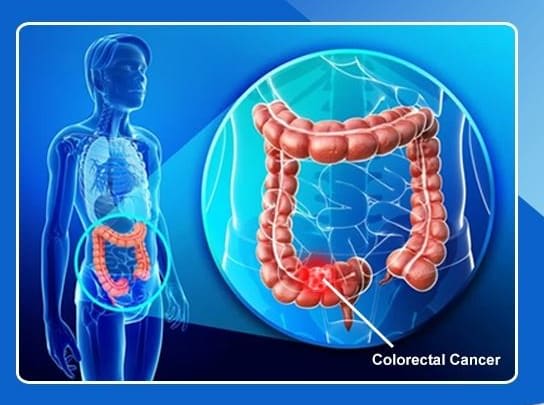 What is Colon cancer