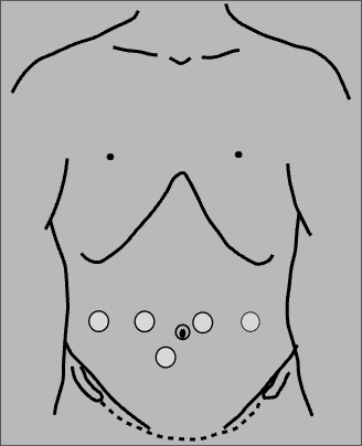 Port placement for robotic completion radical cholecystectomy