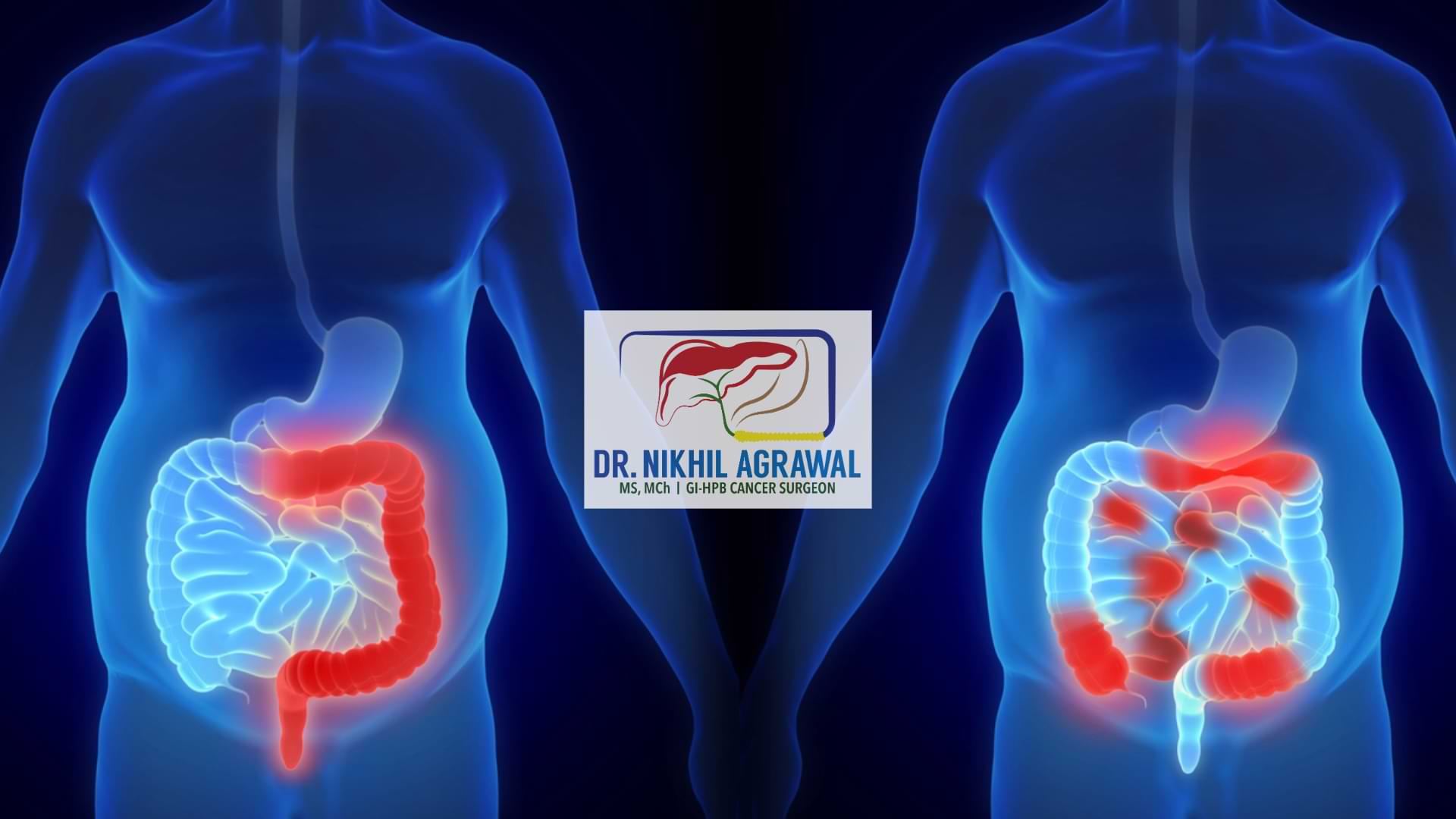 Ulcerative colitis and Crohn's disease