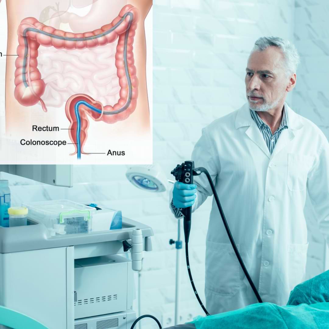Colonoscopy