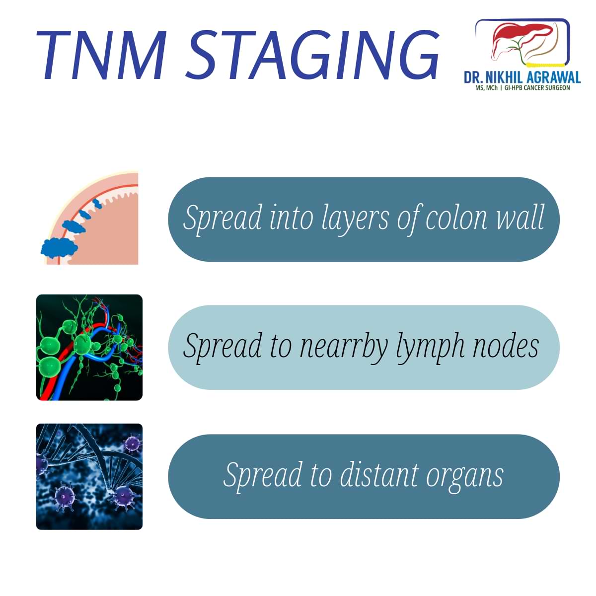 Colon cancer TNM stage