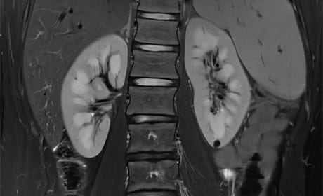 Reducing scan time and simultaneously improving image quality in ...