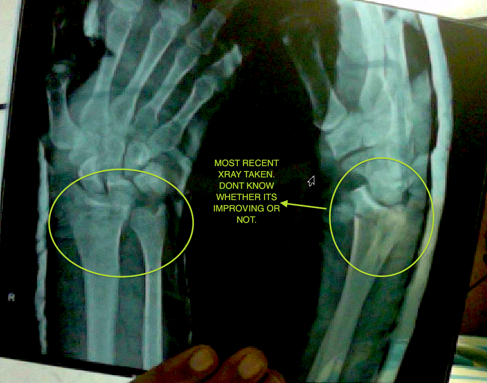 X-ray of wrist fracture