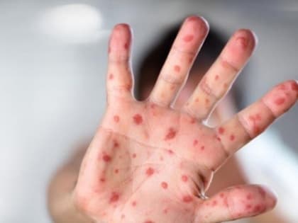 Как защититься от кори в Новокузнецке