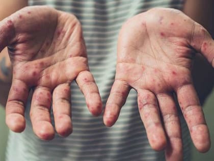 Новую пандемию вызовет корь?!