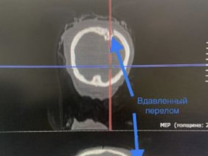 Хирурги спасли жизнь попавшего под поезд пациента