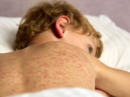 В Прокопьевске зафиксировано 25 случаев заражения корью