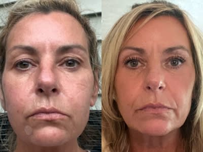 Dacial balancing with Dermal Filler