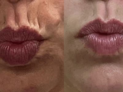 Dermal Lip Filler