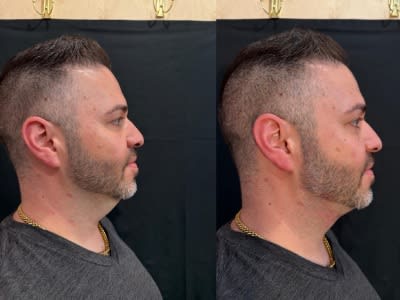 Dermal filler and PDO thread