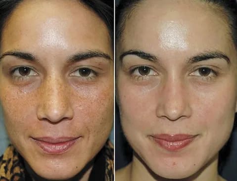 chemical peel