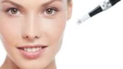 Microneedling treatment