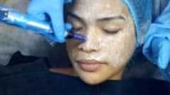 BB Glow Microneedling Training