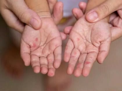 Отёки и сухой кашель: Роспотребнадзор рассказал о первых симптомах кори