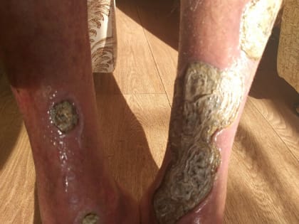 «Все врачи, кто его видят, хватаются за голову»: благовещенцу, который может лишиться ног, срочно нужна помощь (фото)