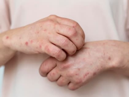 «Опять пандемия?»: амурчан предупредили об опасности кори