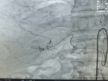 Амурские хирурги впервые провели уникальную операцию на печени