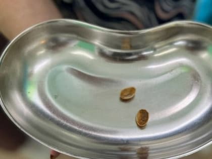 Женщина поперхнулась фисташкой и забыла, а через год чуть не задохнулась