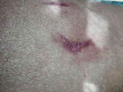 Женщине, искусанной злобной чипированной собакой, администрация Благовещенска выплатит компенсацию(фото 18+)