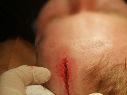 «У меня лилась кровь, левый глаз был закрыт»: конфликт соседей в Чигирях закончился разборкой с арматурой (фото, видео)