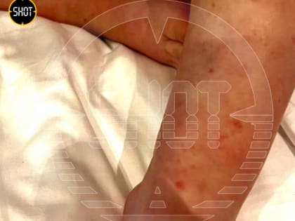 В Белеке зафиксированы случаи высокой температуры у отдыхающих