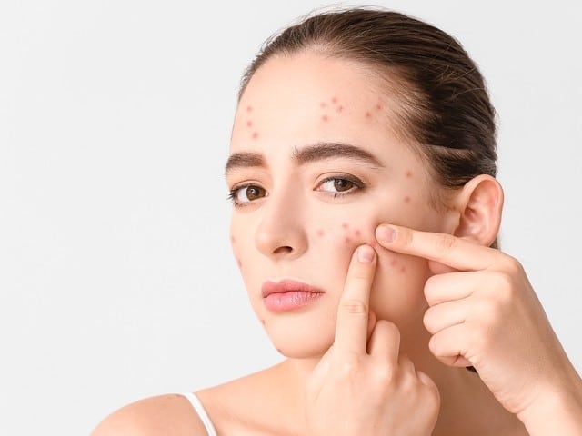 ব্রণ দূর করার উপায়: কার্যকর Acne Solution ও K-beauty স্কিন কেয়ার টিপস