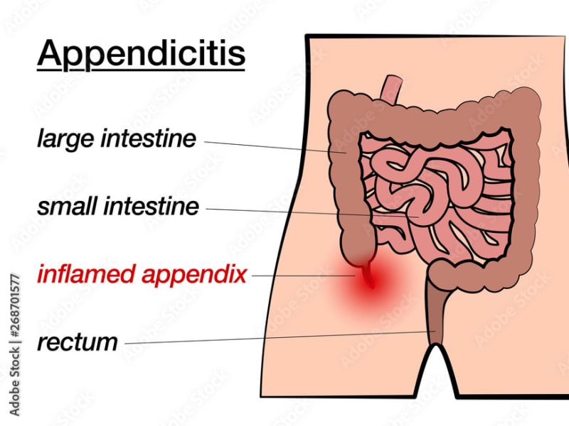 What Is Appendicitis? A Simple Guide to Your Tummy’s Little Tail