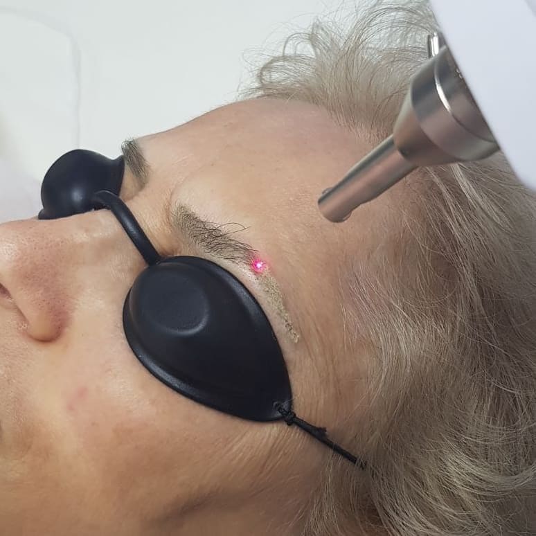 Elimina cejas tatuadas con láser