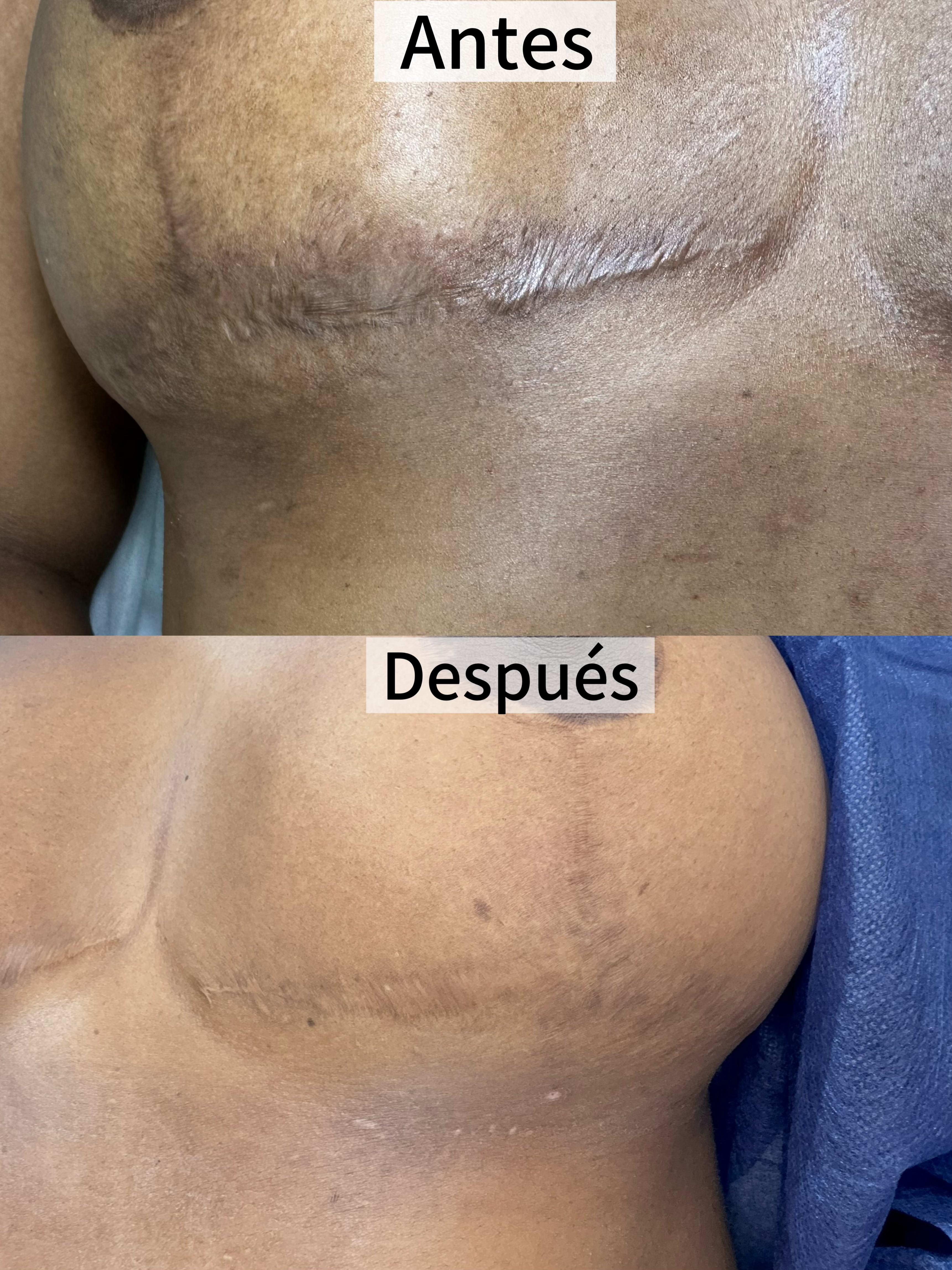 Camuflaje en cicatriz