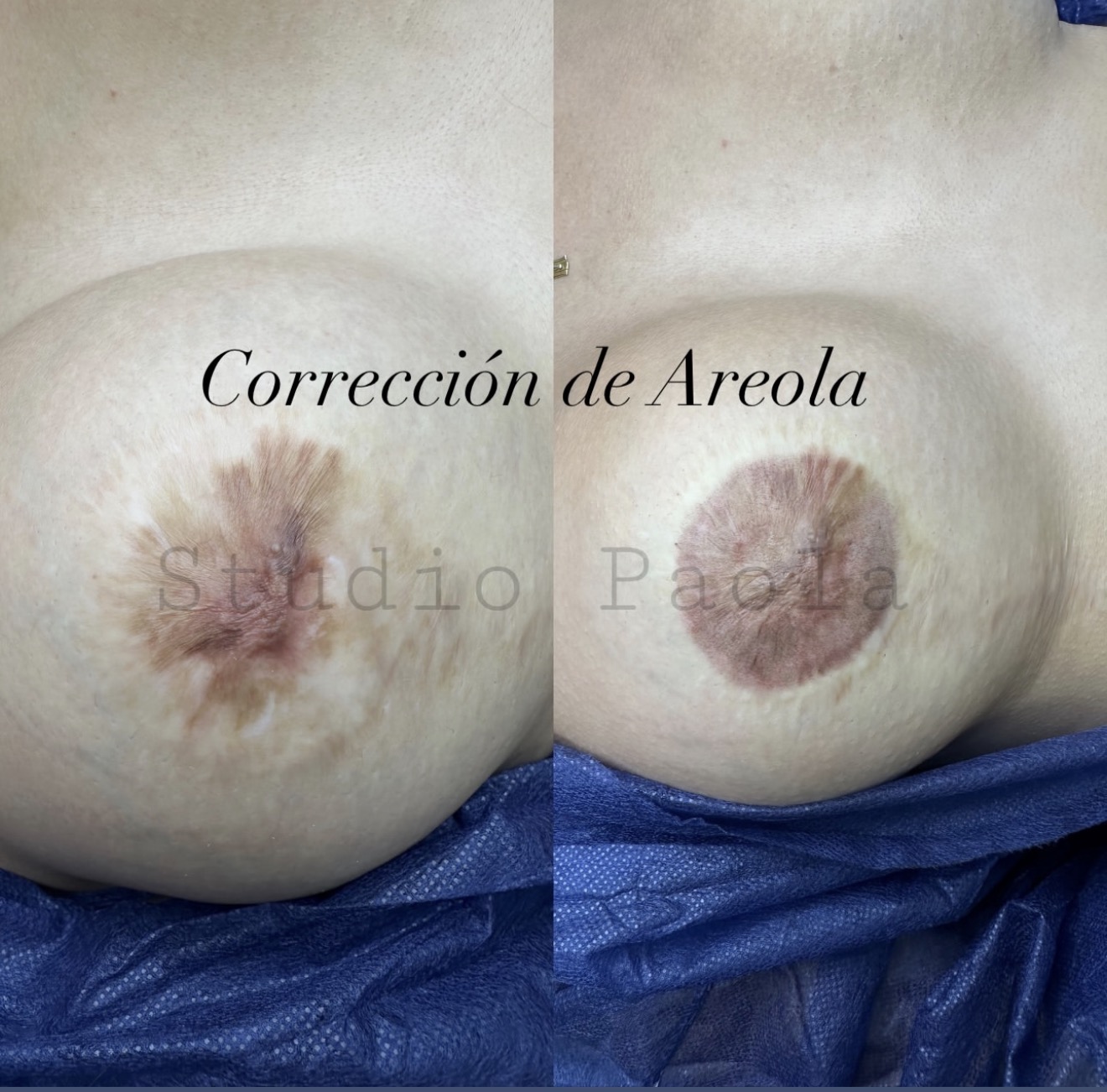 Corrección de areola