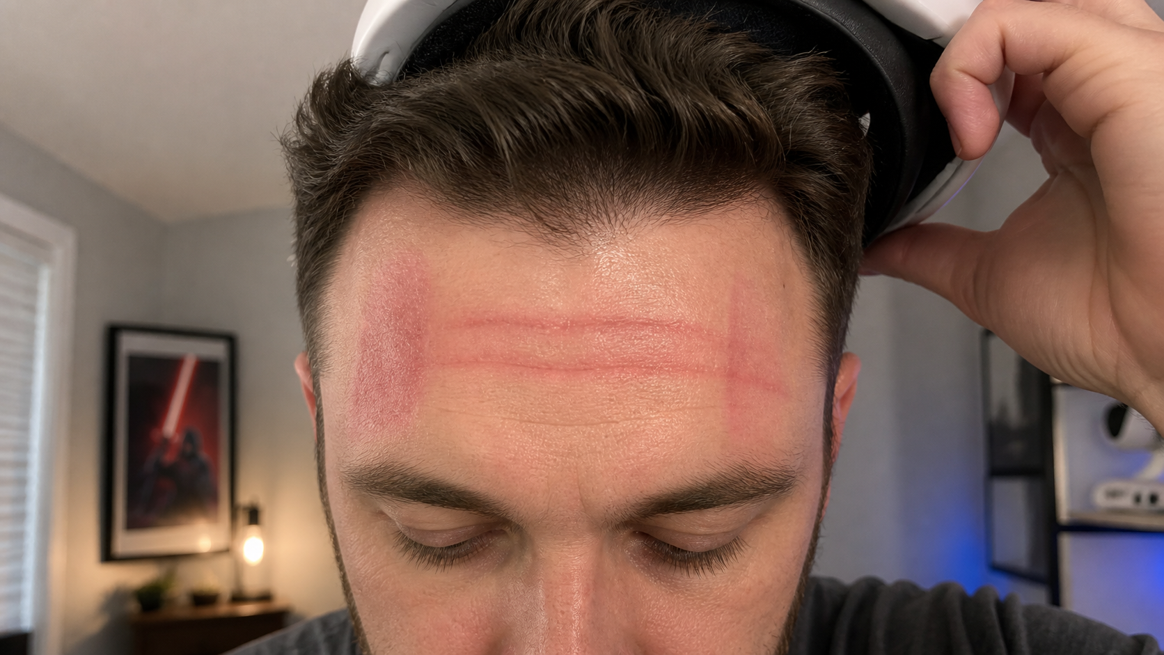 A person's forehead shown after removing a VR headset, with distinct red pressure marks left by the strap.