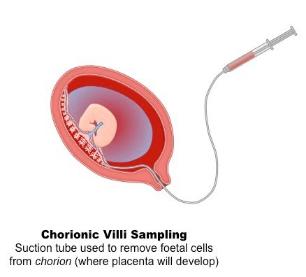 The Role of Amniocentesis and CVS in Pregnancy